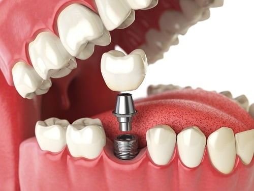 fog implantátum