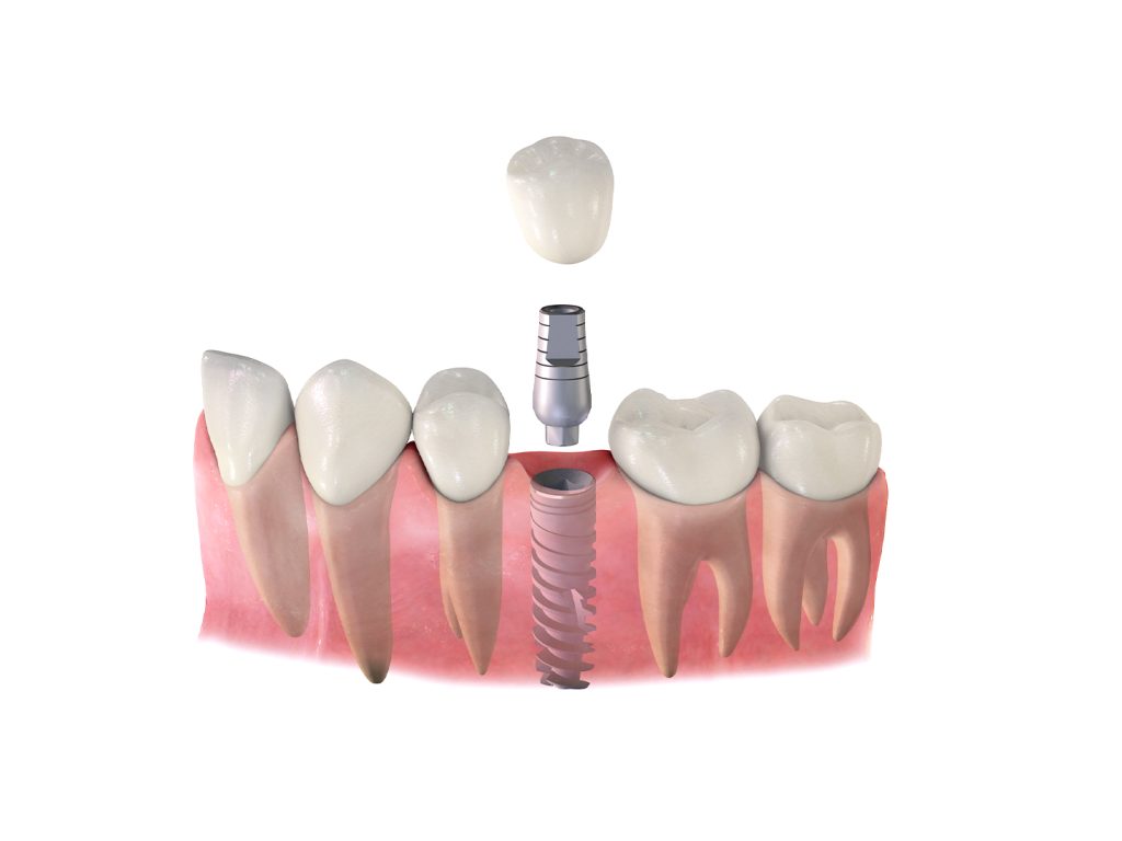 fog implantátum