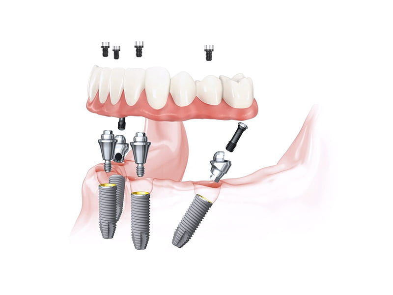 All-on-4 legjobb fog implantátum